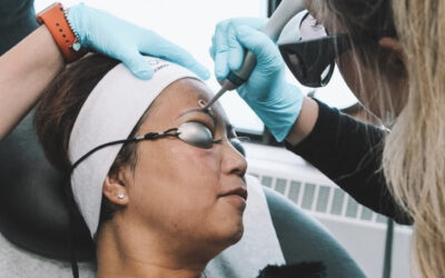 Patient in goggles receiving PicoWay on forehead
